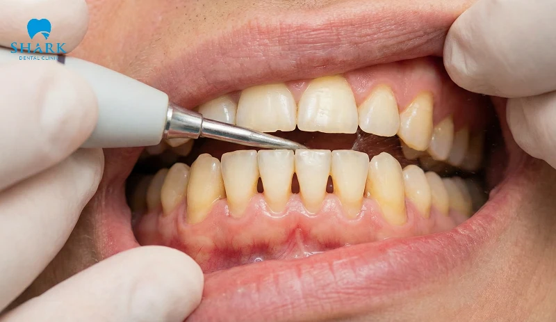 Hở kẽ chân răng khi lấy cao răng không đúng kỹ thuật