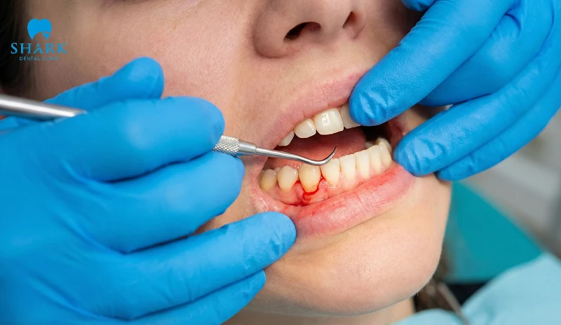 Tổn thương mô mềm và chảy máu kéo dài