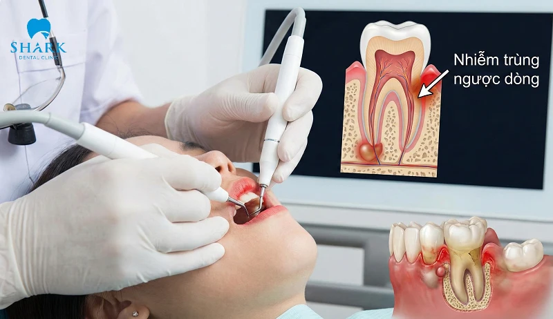 Lấy vôi răng sai cách có thể gây nhiễm trùng máu đối với người có tiền sử bệnh
