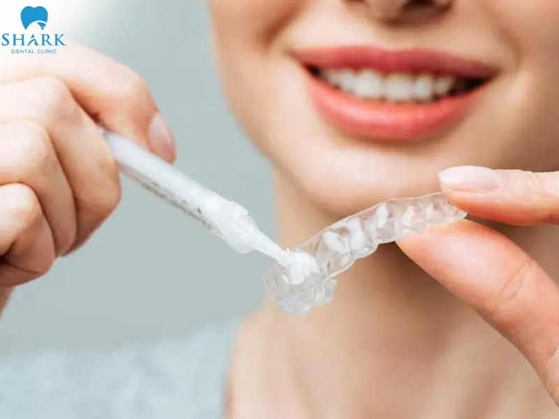 Bơm gel vào máng trắng răng