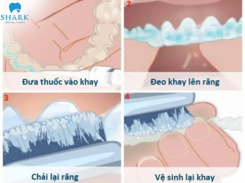 Cách vệ sinh máng răng