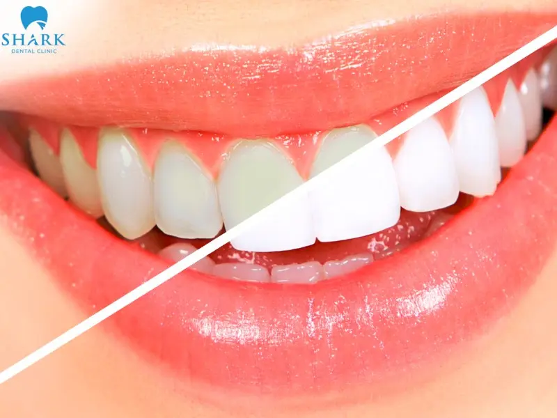 Tẩy trắng răng bằng thuốc tẩy trắng răng