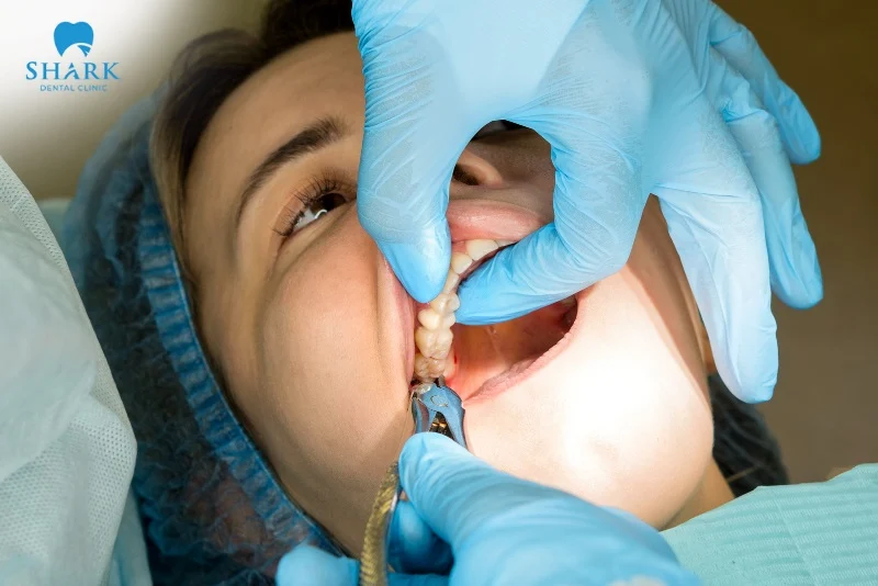 tiểu phẫu răng khôn