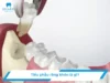 Tiểu phẫu răng khôn là gì? Những lưu ý quan trọng