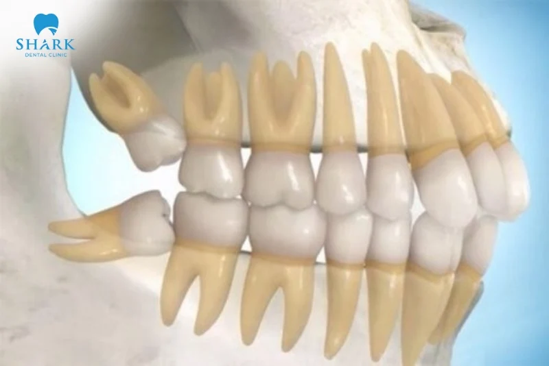 răng khôn mọc lệch