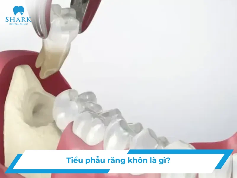 Tiểu phẫu răng khôn là gì? Khi nào nên thực hiện? 7 tiểu phẫu răng khôn