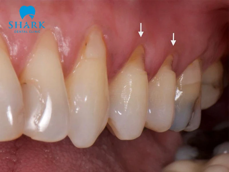 Trám mòn cổ chân răng để bảo vệ tủy