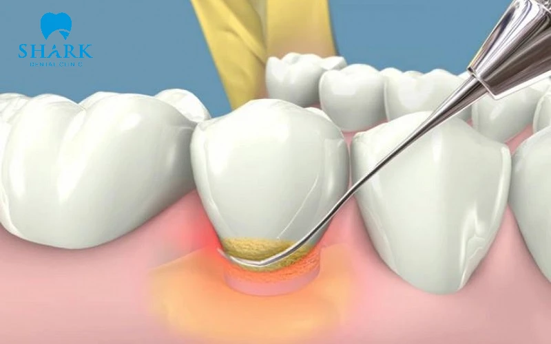 Trám mòn cổ chân răng là giải pháp hiệu quả để ngăn ngừa mất răng