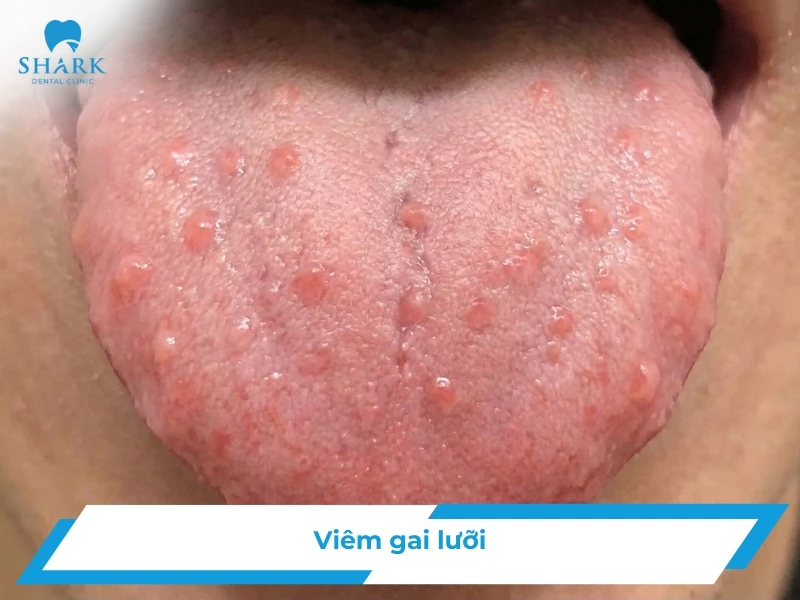 Hình ảnh viêm gai lưỡi