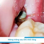 Màng trắng sau khi nhổ răng