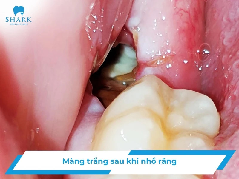 Màng trắng sau khi nhổ răng là gì? Là dấu hiệu tốt hay xấu? 8 Màng trắng sau khi nhổ răng