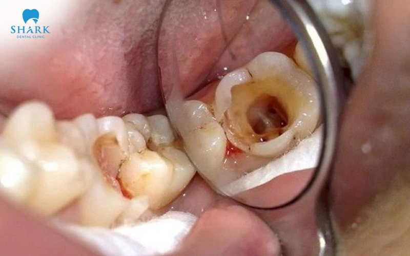 Bựa răng lâu năm có thể gây ra nhiều bệnh lý dẫn đến mất răng