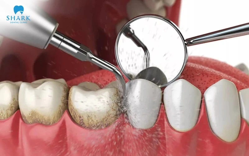 Cạo vôi răng tại Nha khoa định kỳ