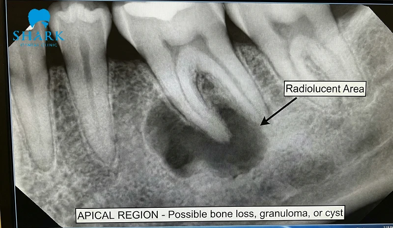 Vùng chóp răng xuất hiện vùng thấu quang ranh giới có thể rõ hoặc không