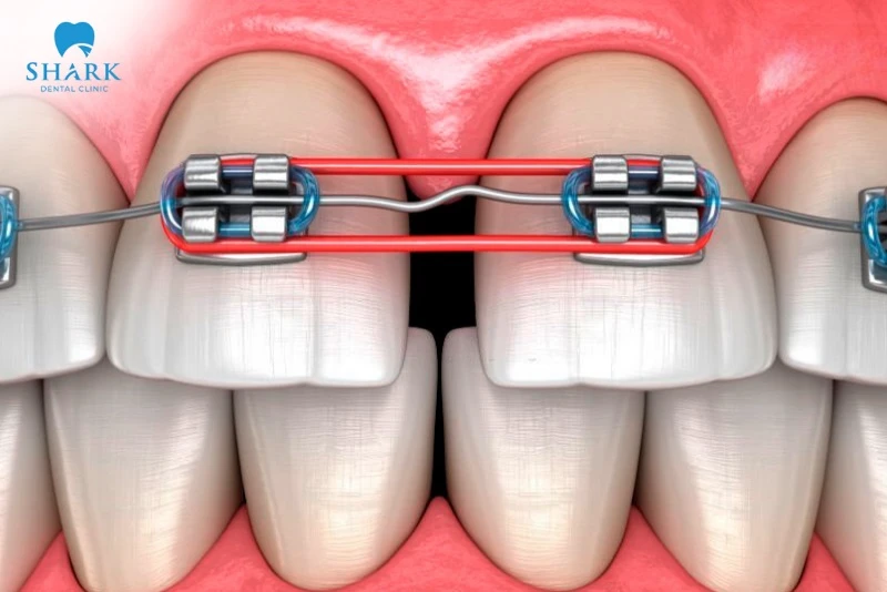 Chun chuỗi giúp đóng các khoảng hở của răng một cách hiệu quả