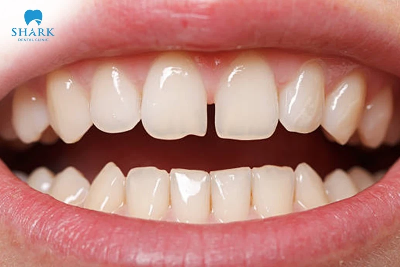 Răng thưa là đối tượng thích hợp để sử dụng chun chuỗi niềng răng