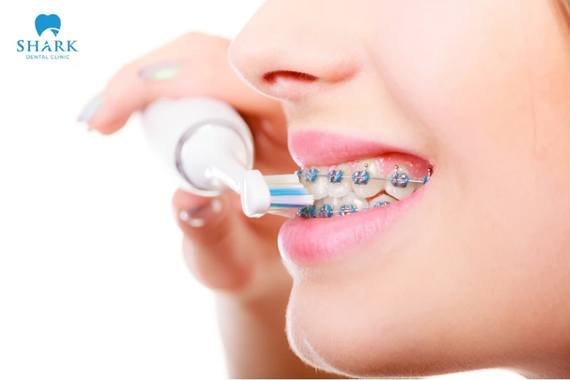 Vệ sinh răng miệng khi đeo chun chuỗi