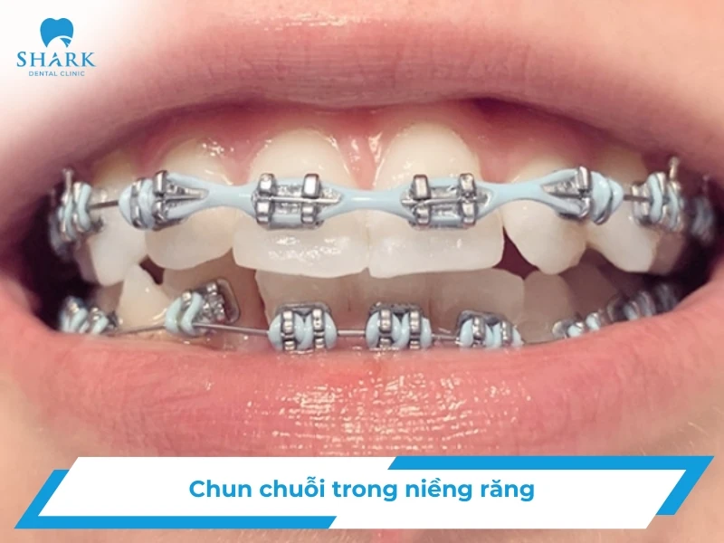 Chun chuỗi niềng răng