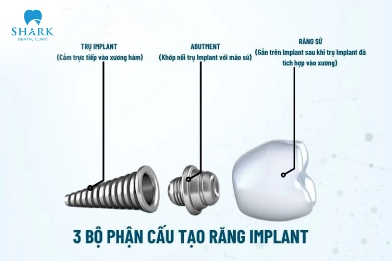 Trụ Implant ETK có nguồn gốc xuất xứ từ đâu? Có tốt không? 10 Cấu tạo của trụ Implant ETK