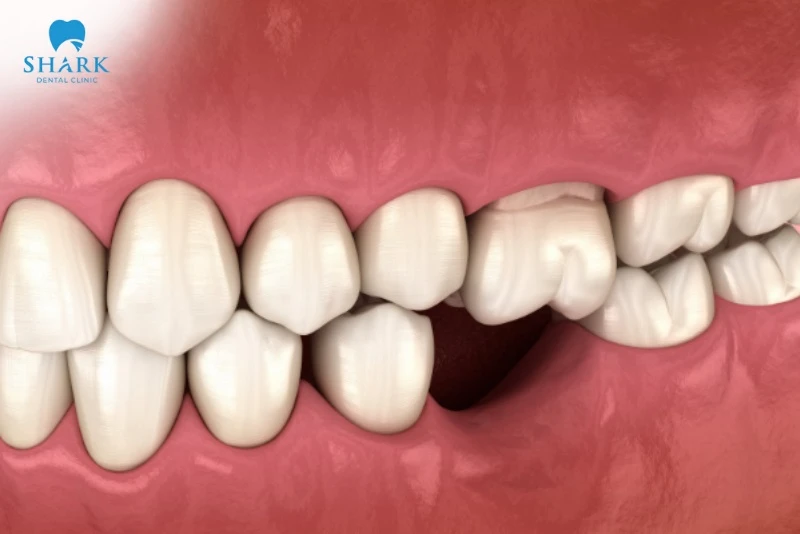 Trụ Implant ETK có nguồn gốc xuất xứ từ đâu? Có tốt không? 11 Trụ ETK phù hợp với người muốn cấy Implant tức thì