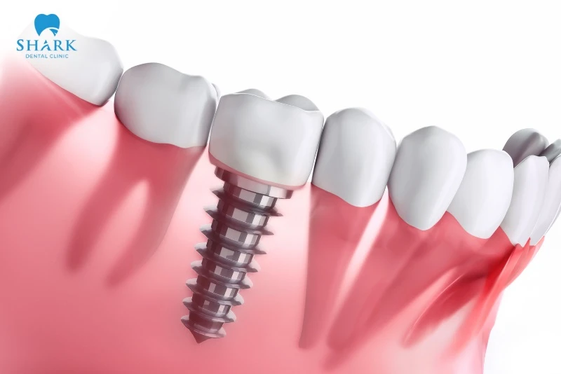 Trụ Implant ETK có nguồn gốc xuất xứ từ đâu? Có tốt không? 12 Trụ ETK phù hợp với người không muốn sử dụng hàm giả tháo lắp