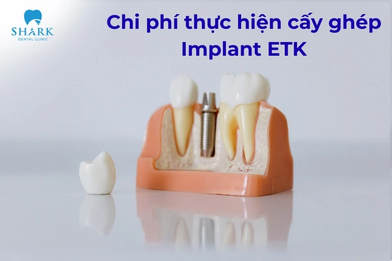 Trụ Implant ETK có nguồn gốc xuất xứ từ đâu? Có tốt không? 13 Giá cấy trụ Implant ETK