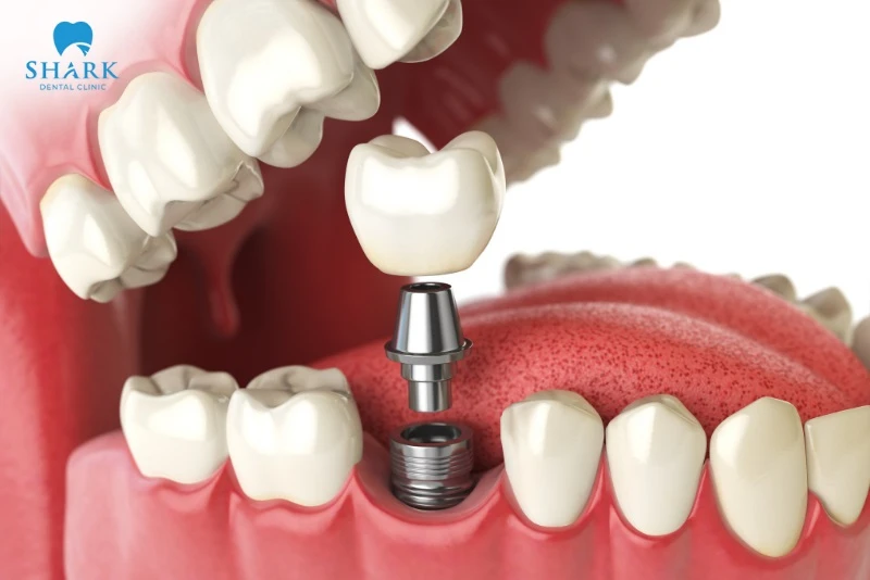 Trụ Implant MIS là gì? Có xuất xứ từ nước nào? 10 Implant MIS có đặc tính phục hồi tốt