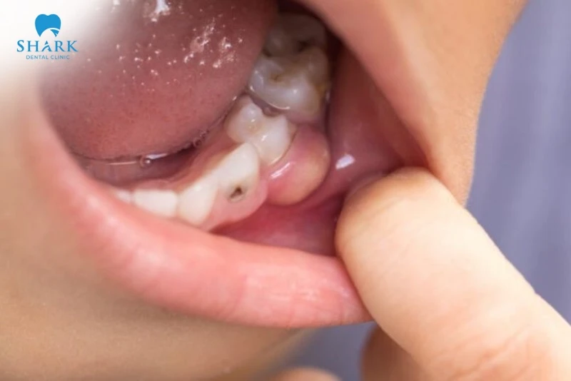 Kháng sinh răng cho trẻ em gồm những loại nào? Liều dùng? 12 Chỉ định dùng kháng sinh cho trẻ em khi trẻ gặp các vấn đề như áp xe răng, viêm nha chu, viêm nướu,...