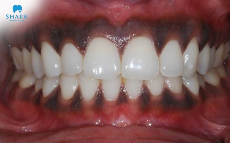 Nướu bị thâm đen do nhiều nguyên nhân hình thành