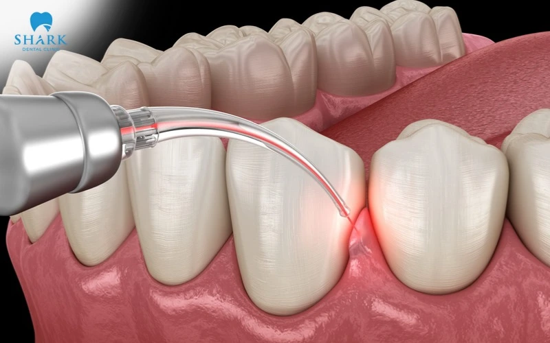 Làm hồng nướu bằng công nghệ Laser