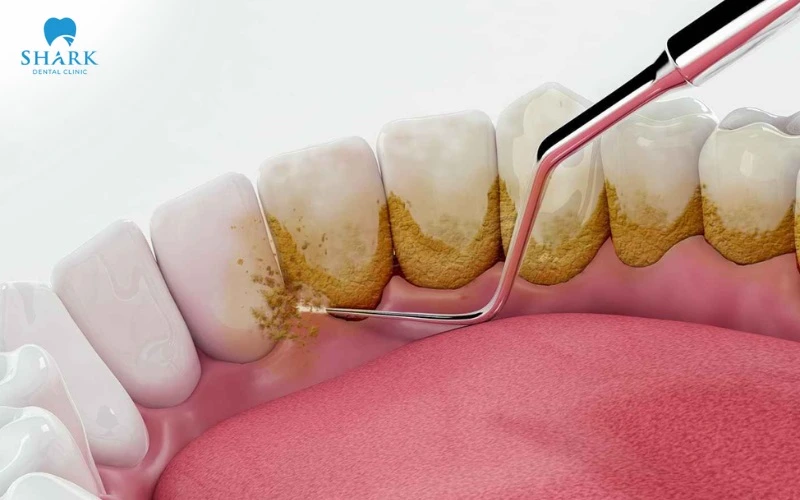 Cạo vôi răng để tránh viêm nhiễm gây thâm nướu