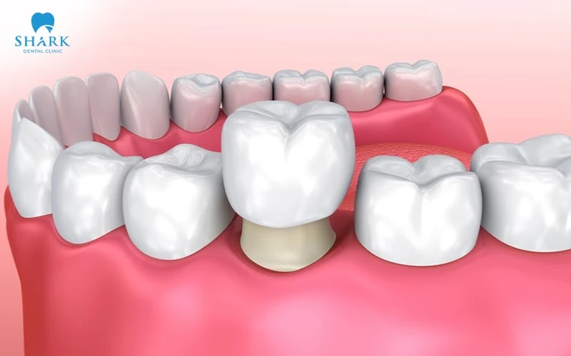 Thay thế mão sứ bằng răng toàn sứ cao cấp