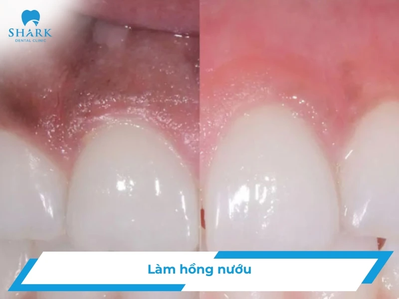 Làm hồng nướu