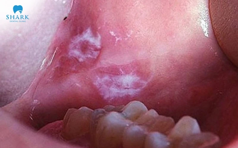 Bị viêm nhiễm lỡ loét do chấn thương từ việc sử dụng khí cụ nha khoa