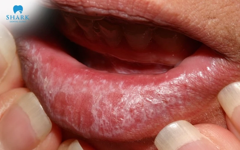 Lichan phẳng ở môi