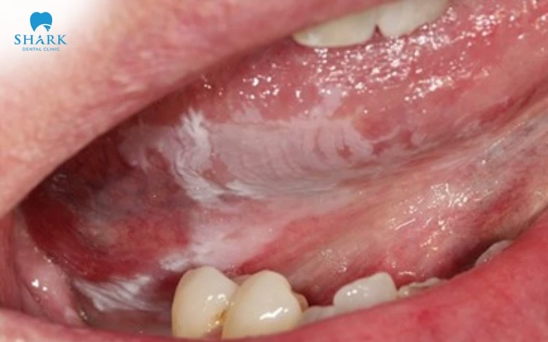 Lichen phẳng ở lưỡi