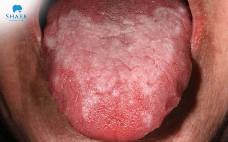 Hình ảnh Lichen phẳng ở toàn bộ lưỡi gây đau rát