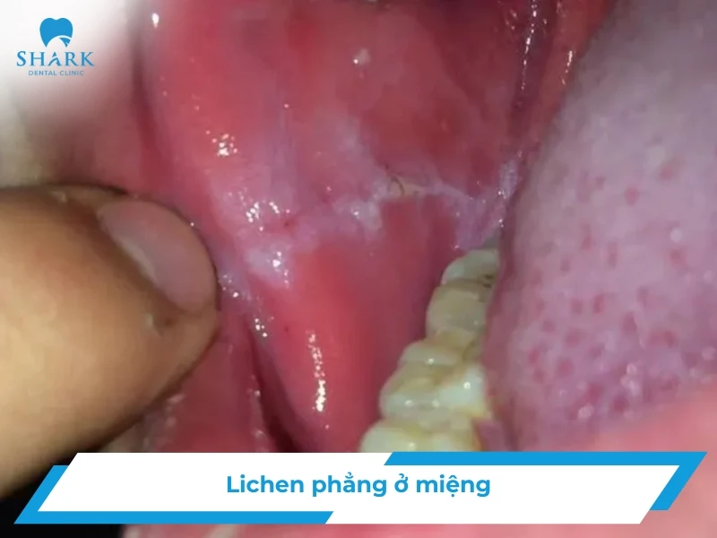 Lichen phẳng ở miệng