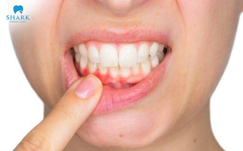 Chân răng bị ngứa