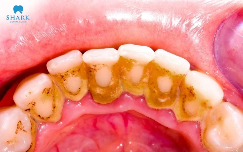 Cao răng tích tụ nhiều cũng gây ngứa chân răng