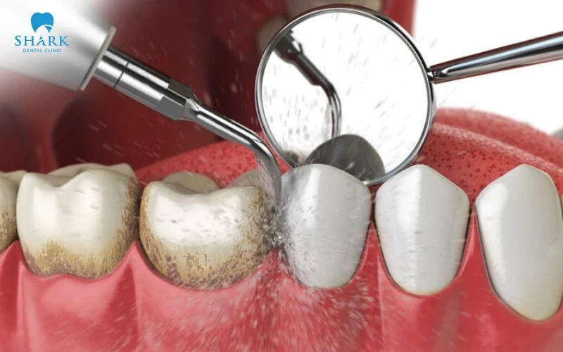Cạo vôi răng định kỳ để không gây viêm nhiễm nướu