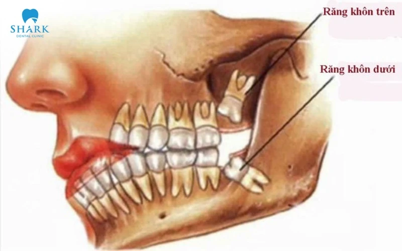 Nhổ răng khôn hàm trên hay hàm dưới nguy hiểm hơn? 5 Chụp X-quang để kiểm tra mật độ xương trước khi nhổ răng khôn