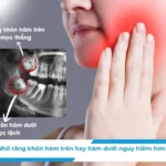 Nhổ răng khôn hàm trên hay hàm dưới nguy hiểm hơn