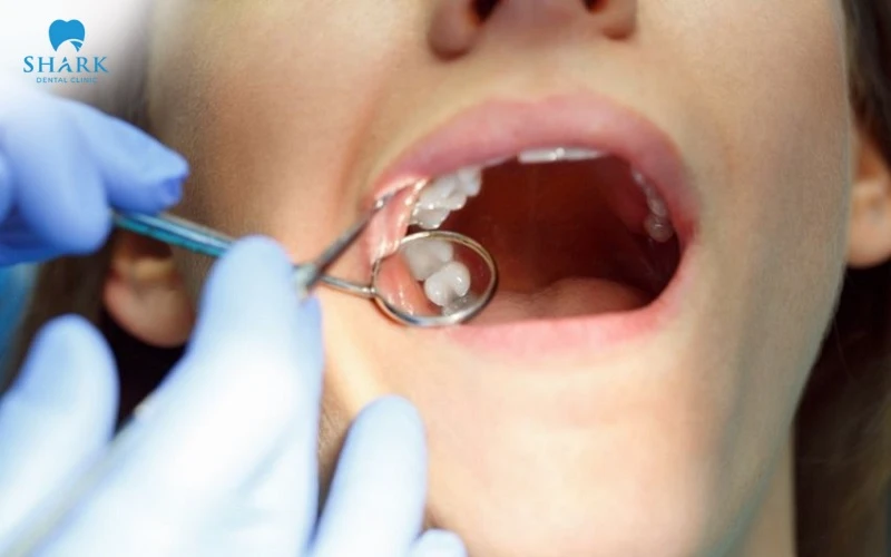 Nhổ răng khôn hàm trên hay hàm dưới nguy hiểm hơn? 6 Nhổ răng khôn hàm dưới sẽ đau hơn sau khi hết thuốc tê