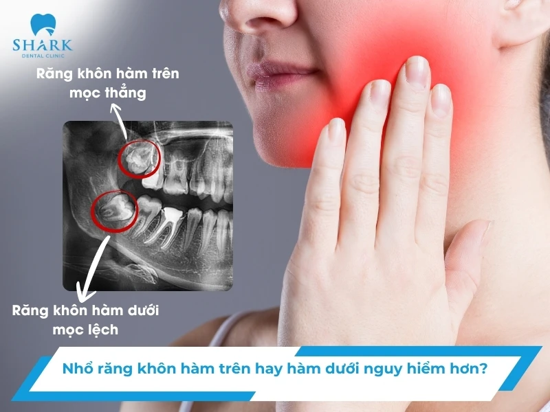 Nhổ răng khôn hàm trên hay hàm dưới nguy hiểm hơn? 20 Nhổ răng khôn hàm trên hay hàm dưới nguy hiểm hơn