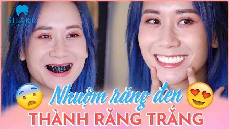 Chuẩn mực cái đẹp về màu răng đã thay đổi