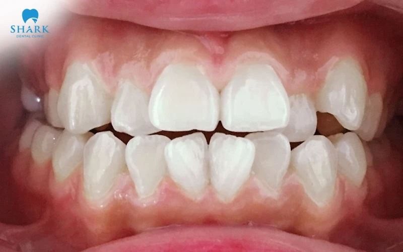 Răng mọc lộn xộn rất phù hợp để niềng răng X-Matrix