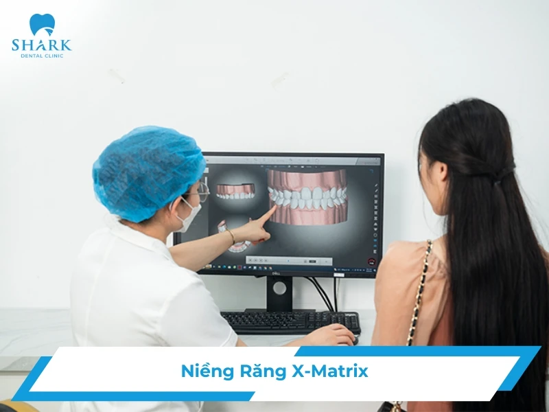 Công nghệ niềng răng X-Matrix là gì? Có ưu điểm gì nổi bật? 10 Niềng răng X-Matrix