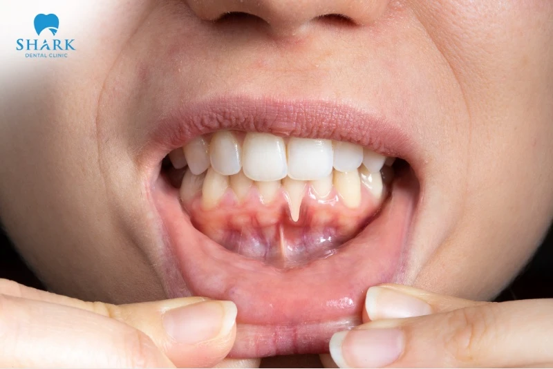 KIN phù hợp nhất với những người đang bị viêm nướu