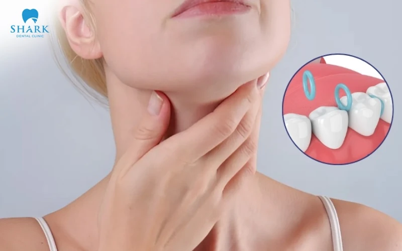 Lỡ nuốt dây thun niềng răng thì bạn cũng không cần quá lo lắng